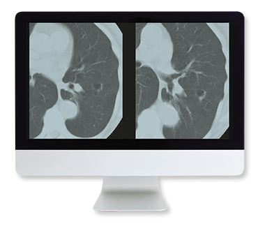 ARRS Lung Cancer Screening A Comprehensive Guide Online Course 2015