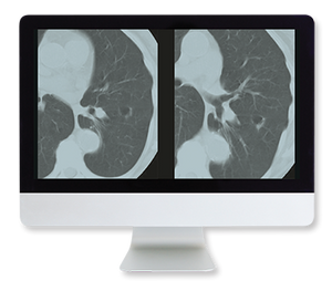 ARRS Lung Cancer Screening A Comprehensive Guide Online Course 2015