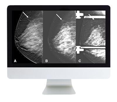ARRS Breast Imaging: Screening and Diagnosis - Medical Videos | Board Review Courses
