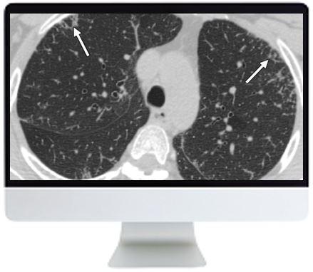 ARRS Clinical Case-Based Review of Cardiopulmonary Imaging 2019 - Medical Videos | Board Review Courses