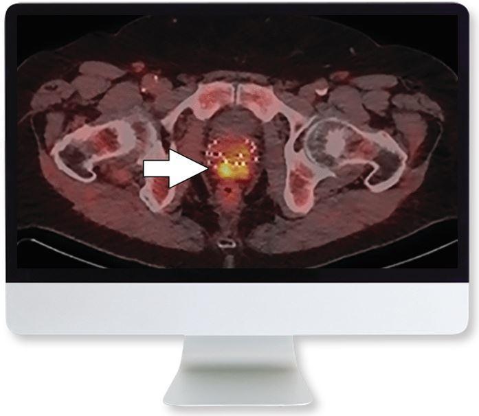 ARRS Molecular Imaging and Therapy of Prostate Cancer 2020 - Medical Videos | Board Review Courses