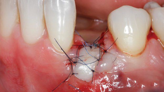 Gidedental Soft Tissue Management around Natural Teeth and Dental Implants 2020 - Medical Videos | Board Review Courses