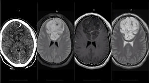 MRIOnline Imaging Mastery Series: Adult Glioma Imaging 2021 - Medical Videos | Board Review Courses