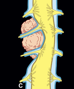 MRIOnline MRI Mastery Series: Extradural Lesions 2020 - Medical Videos | Board Review Courses