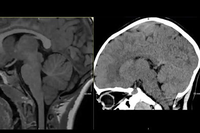 MRIOnline MRI Mastery Series: Infratentorial/Posterior Fossa Defects 2021 - Medical Videos | Board Review Courses