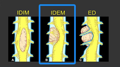 MRIOnline MRI Mastery Series: Intradural Extramedullary Lesions (IDEM) 2020 - Medical Videos | Board Review Courses